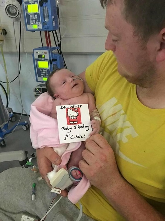 baby ava was diagnosed with gastroschisis