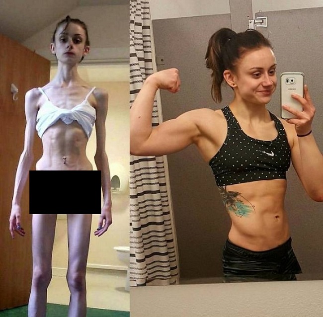 girl suffering Anorexia 