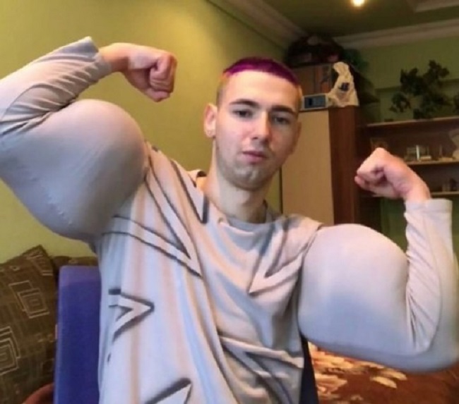 He injected synthol into his arms to look like a bizarre popeye