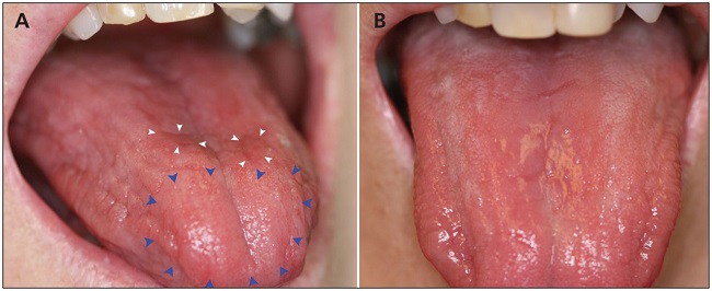 Red smooth tongue