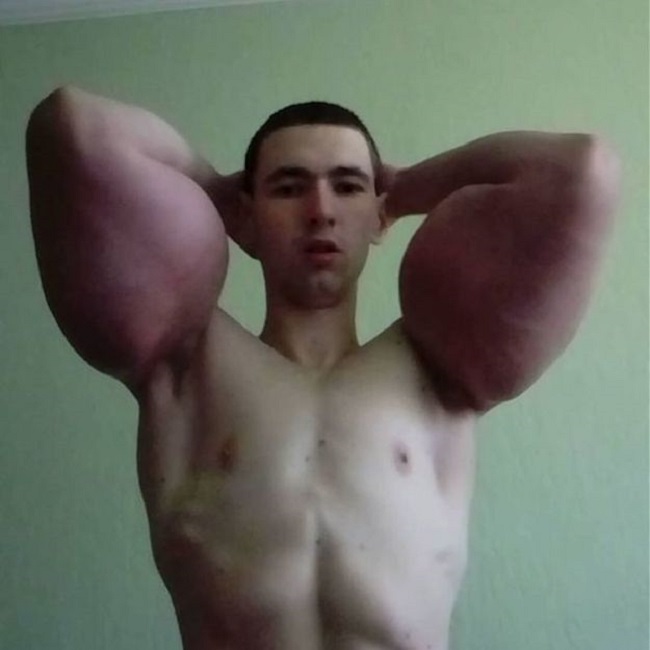 The side effects of synthol enhancements for muscle building