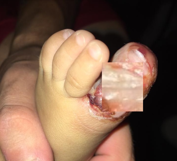 wound on the toe