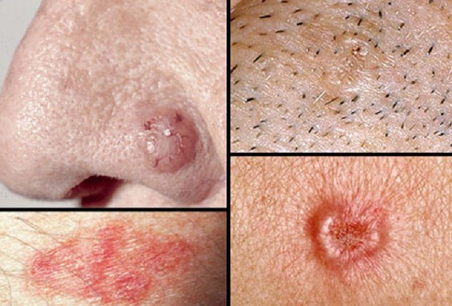 Basal cell carcinoma (cancerous)