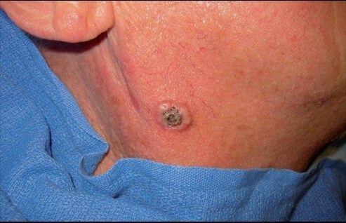 Melanoma (cancerous