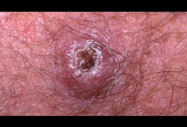 Squamous cell carcinoma