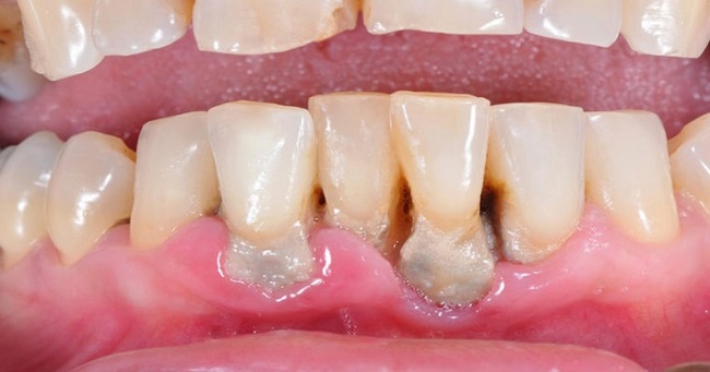 Gum Disease