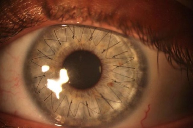 Cornea transplant