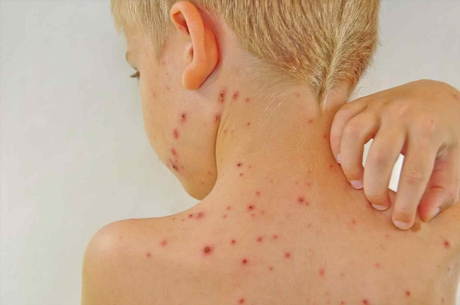 Soothe chicken pox