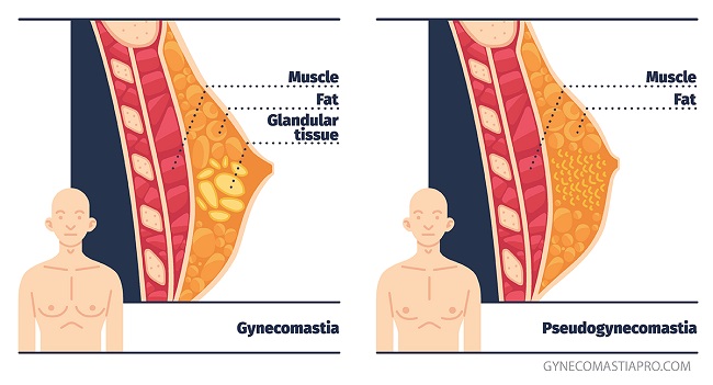 Do you have chest fat or gynocomastia