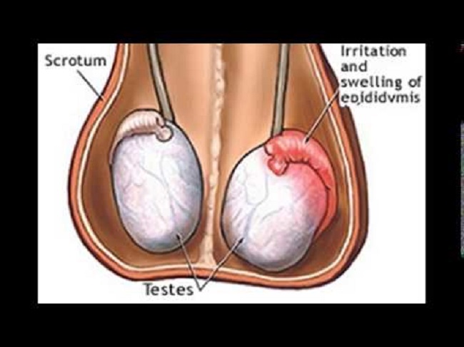 Testicle disease