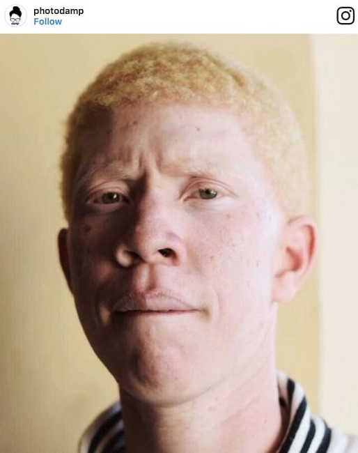 Albino from Venezuela