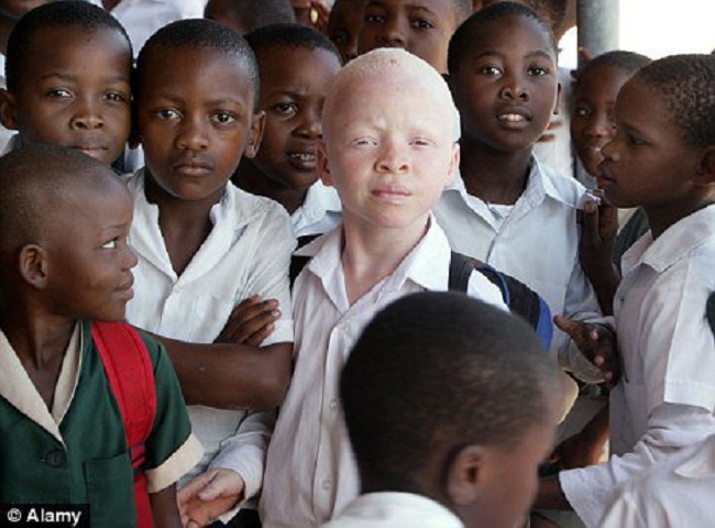 Albinos are hunted in Kenya