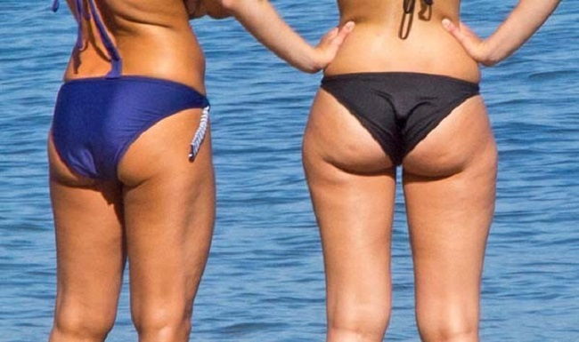 Cellulite can be very hard to remove