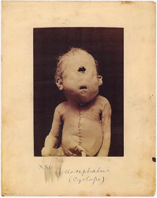 Cyclopia