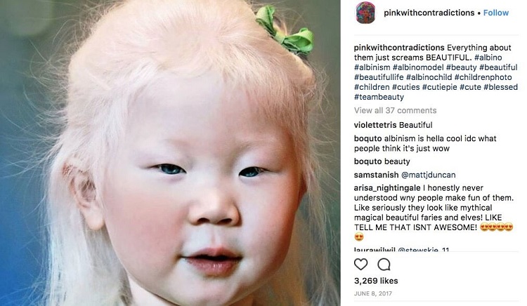 Myths about Albinos