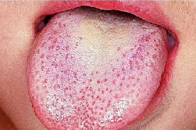 scarlet fever symptoms