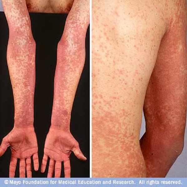 scarlet fever symptoms visible on body