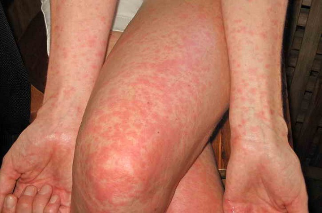 vaccine for scarlet fever 