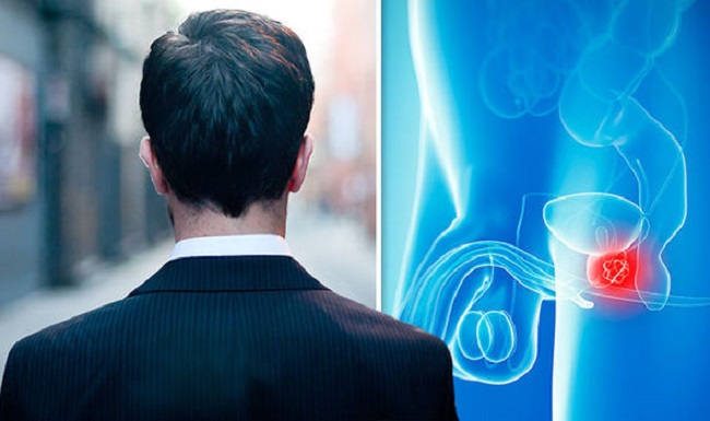 What causes enlarged prostate