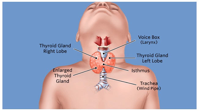 Anxiety and irritability in Hyperthyroidism