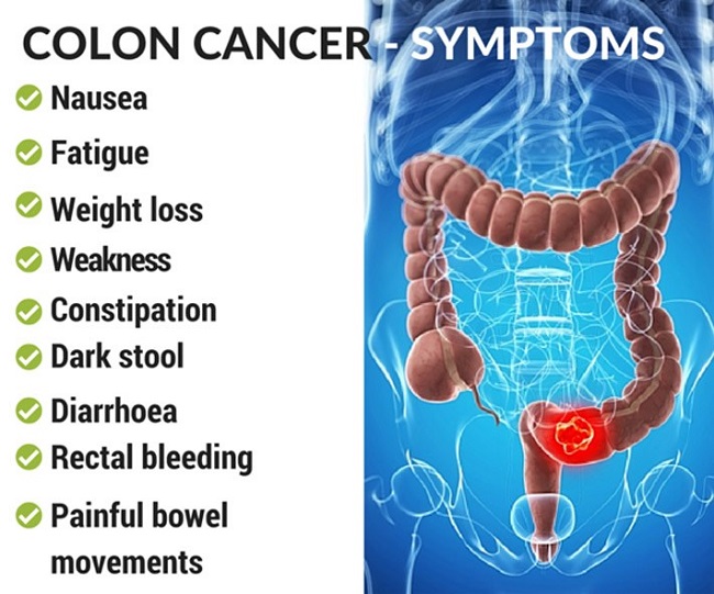 colon cancer symptoms 