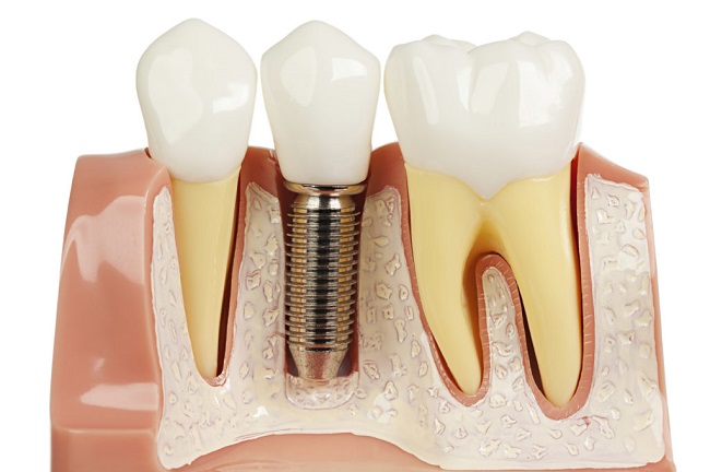 dental implants