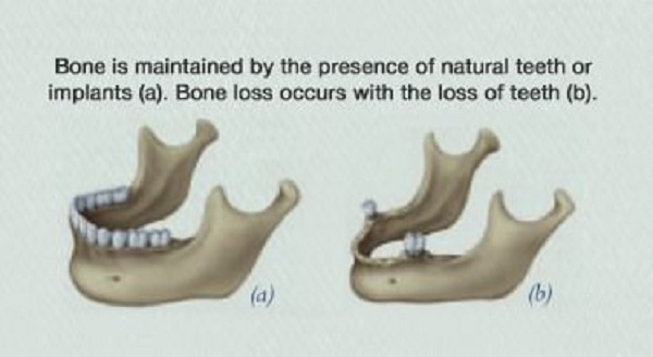 Dental implants stop Bone Loss