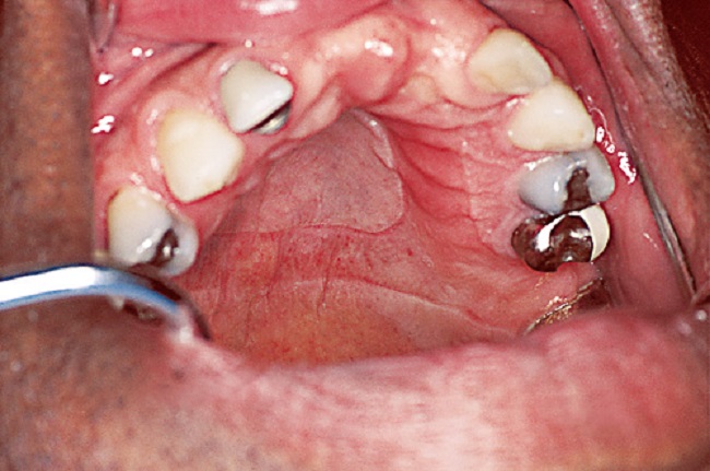 Denture thrush and stomatitis