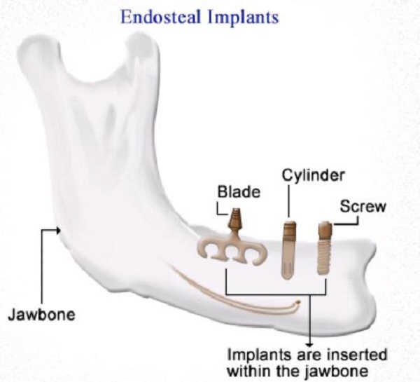 Endosteal implant