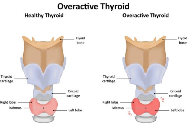 Further symptoms of Hyperthyroidism