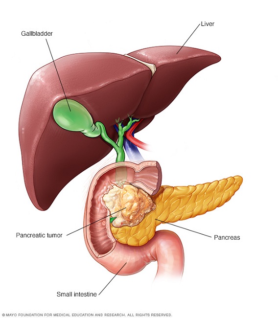 Pancreatic cancer has a high mortality rate