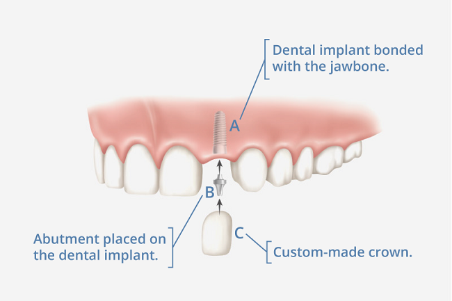 What are dental implants