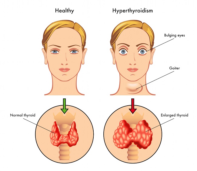 What is Hyperthyroidism