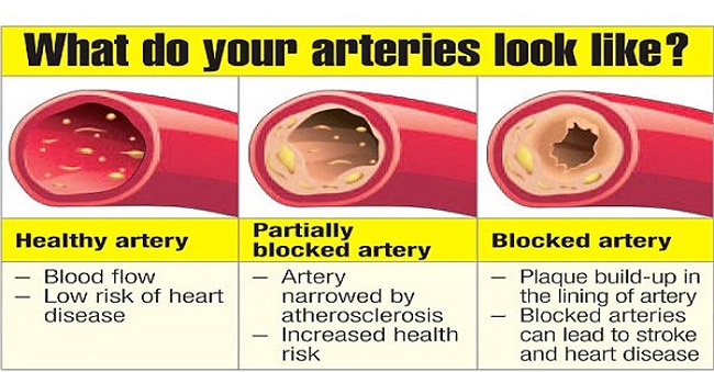 Clogged arteries