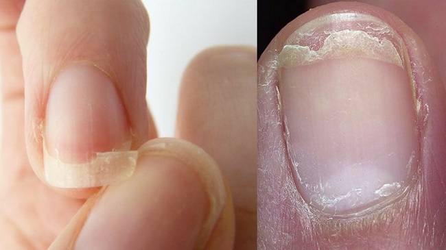 Cracked or weak nails