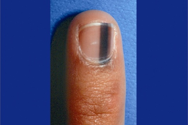 Dark pigment streaks on nails