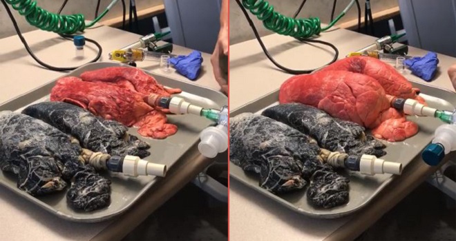 difference between non-smoker and smokers lung