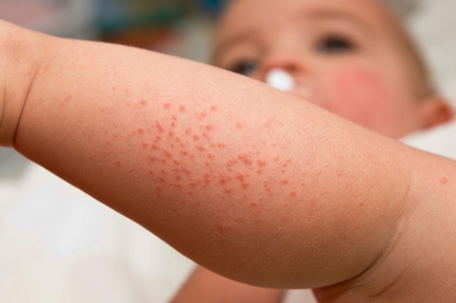 Eczema in kids