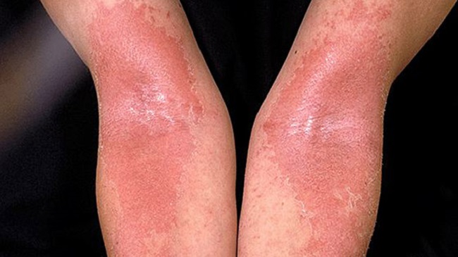 Eczema skin