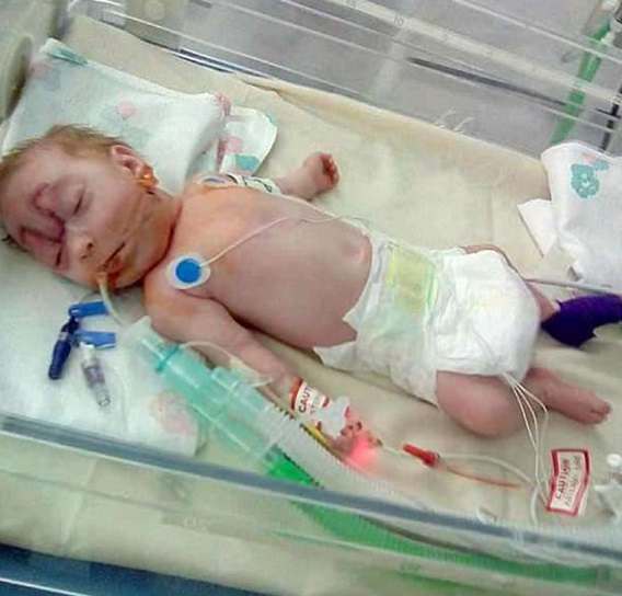 Encephalocele Karlie