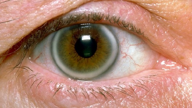 Gray ring around the cornea