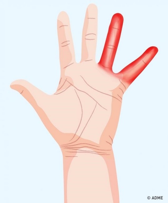 Hand signs that signal spine damage