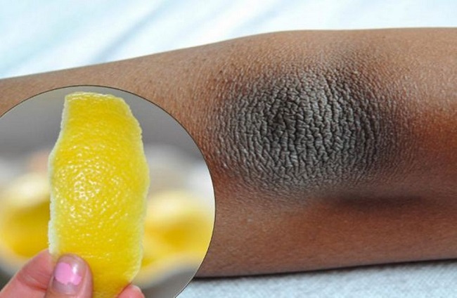 Lemon for dark elbow