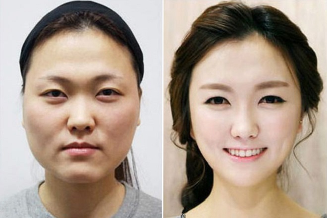 plastic surgery in south korea