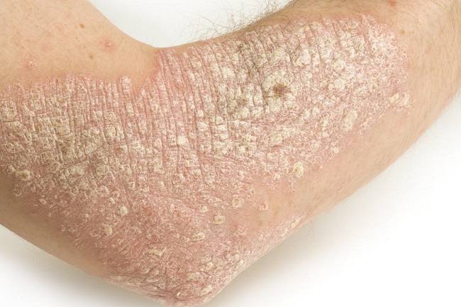 Scaly condition of eczema