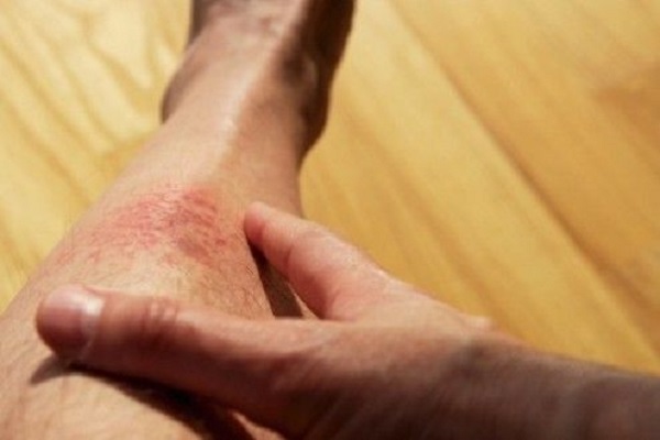 Stress causes of eczema