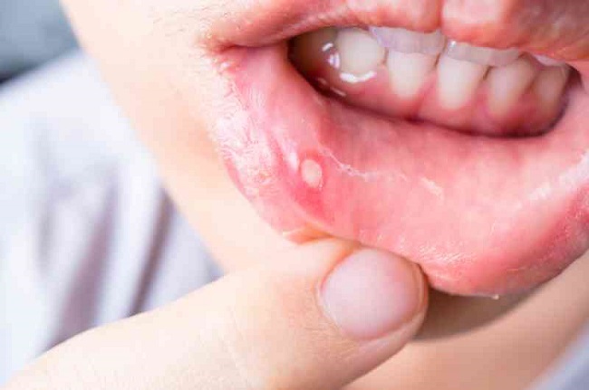 Treat ulcers with aloe vera