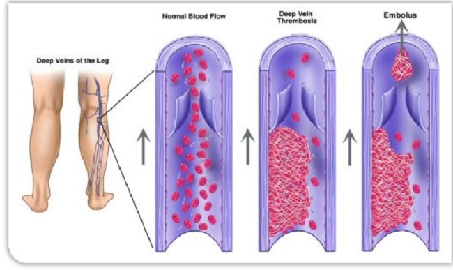 Types of blood clots