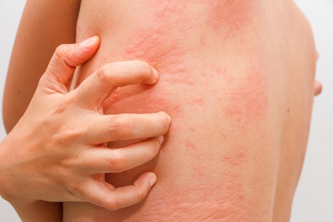 Urticaria disease