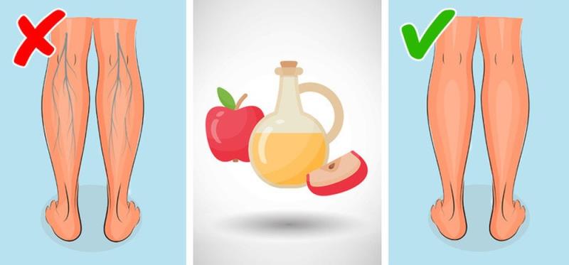 Apple cider vinegar